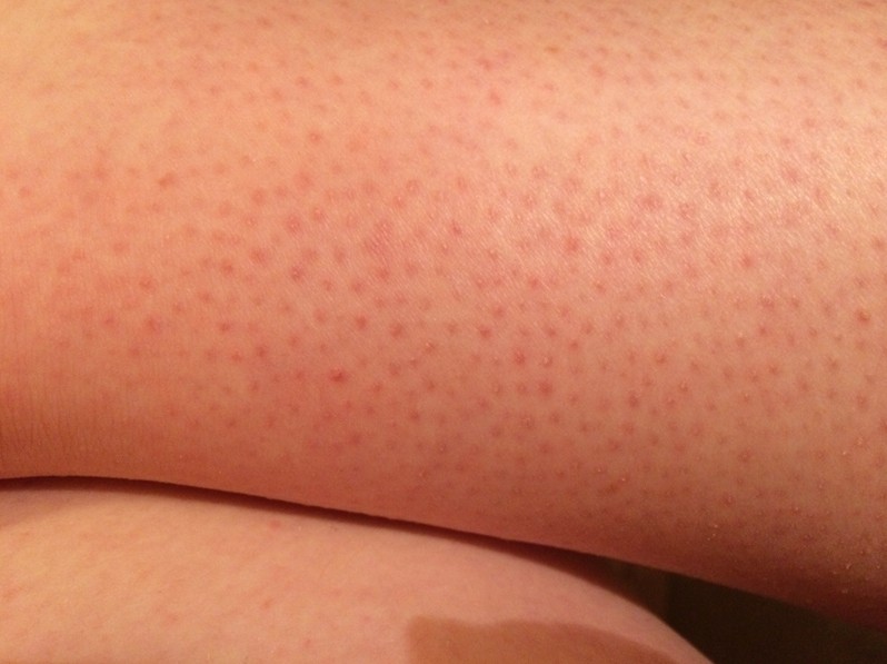 red dots on legs pictures
