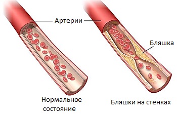 Заболевание сосудов