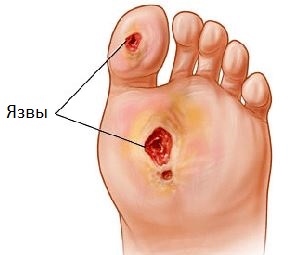 Диабетическая стопа