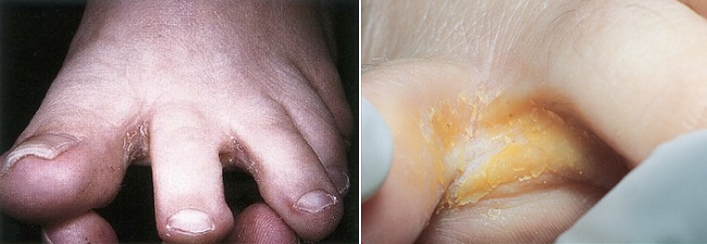 Эритразма между пальцами ноги
