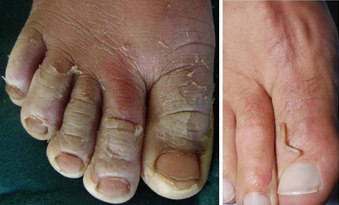 Синдром ошпаренной кожи на пальцах ног