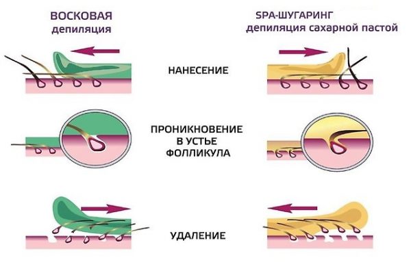 Схема депиляции волос воском и сахарной пастой