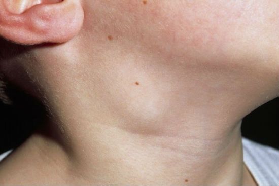 Увеличение лимфоузла на шее у ребенка