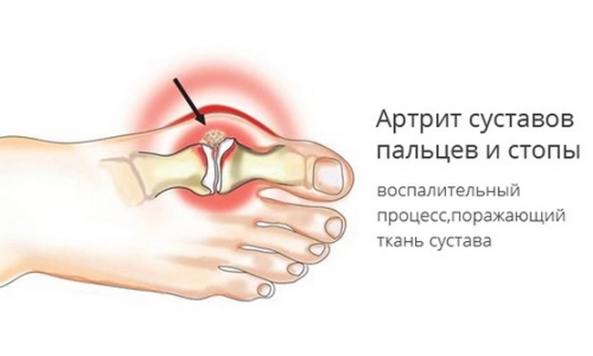 Артрит большого пальца ноги