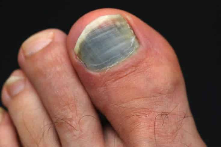 почему синеют ногти на ногах