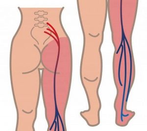 Седалищный нерв и боль при ишиасе