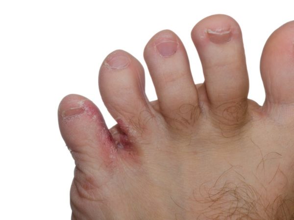Развитие грибка между пальцами ног