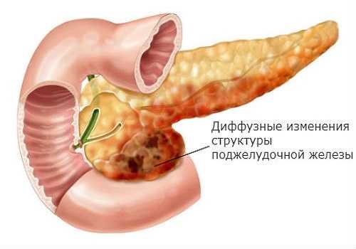 Диффузные изменения поджелудочной железы