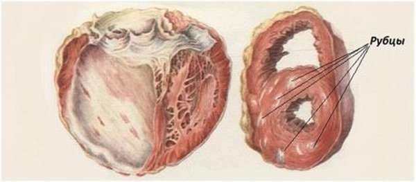 Причины развития кардиосклероза сердца, симптомы заболевания, его диагностика и правила лечения
