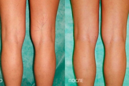 Ноги до и после проведения процедуры