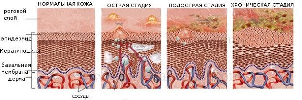 Стадии болезни