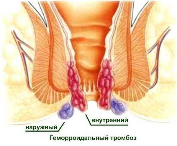Острый тромбоз геморроидального наружного узла