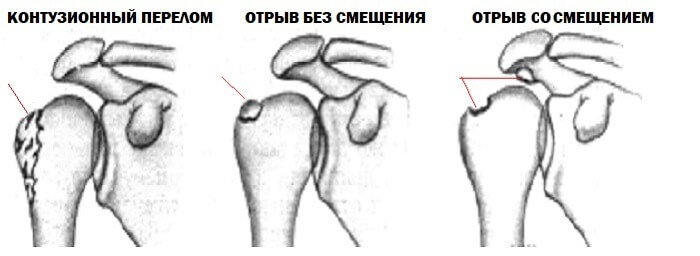 Виды переломов бугорка