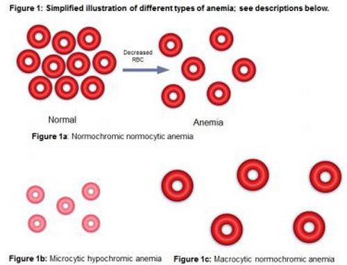 An image that shows a simplified illustration of various types of anemia.image