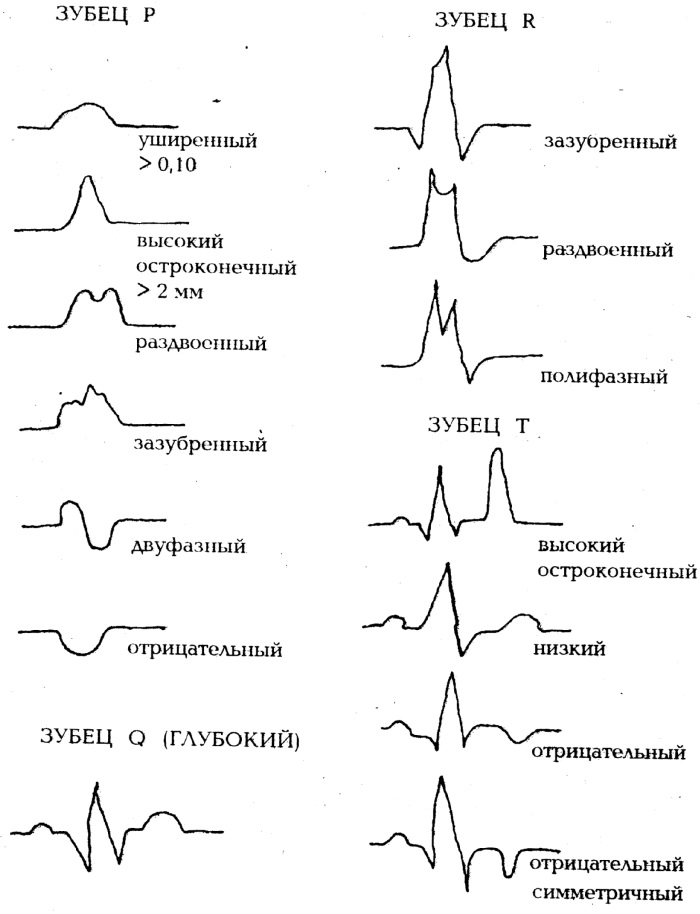 Расшифровка ЭКГ у взрослых. Норма: синусовый ритм, параметры, патологии