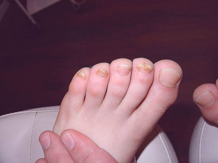 трещины на пальцах ног