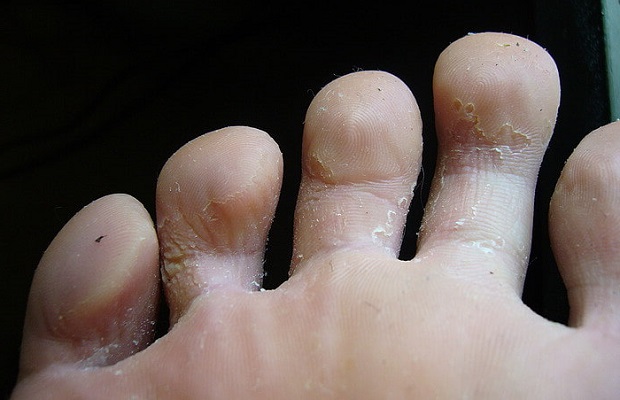 шелушение между пальцев ног