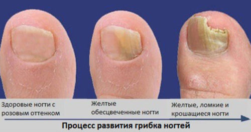 развитие грибка ногтей
