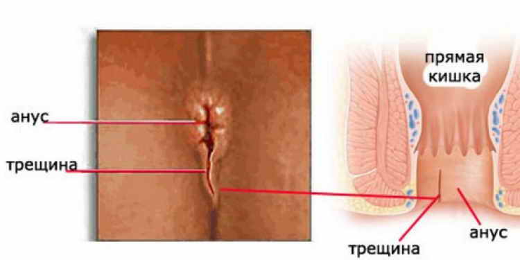 кровотечение из заднего прохода
