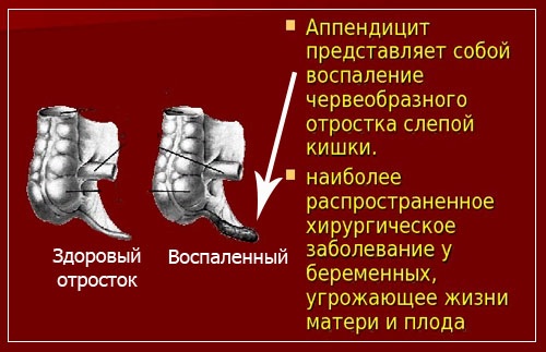 Аппендицит у беременных. Симптомы на поздних, ранних сроках. Операция, последствия