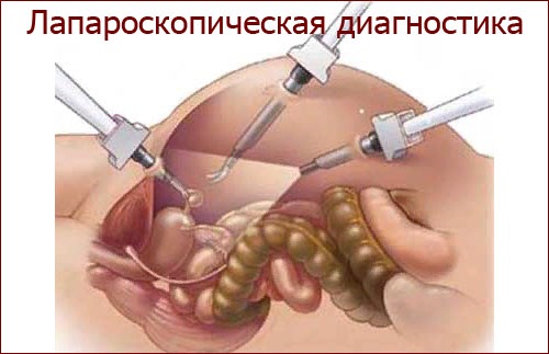 Аппендицит у беременных. Симптомы на поздних, ранних сроках. Операция, последствия