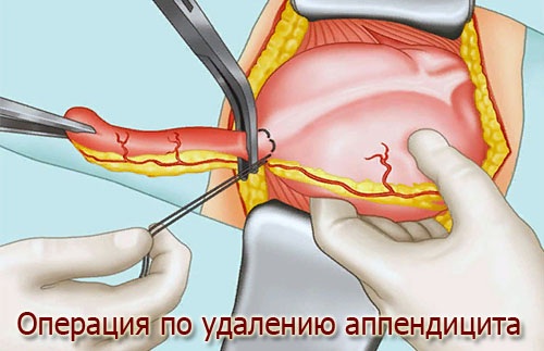 Аппендицит у беременных. Симптомы на поздних, ранних сроках. Операция, последствия