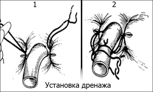 Аппендицит у беременных. Симптомы на поздних, ранних сроках. Операция, последствия