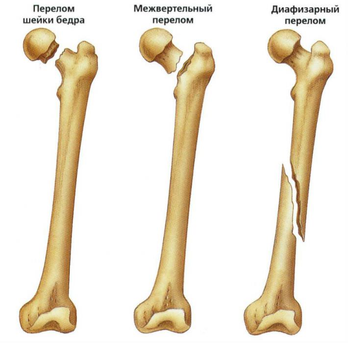 Переломы костей