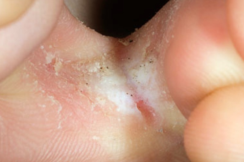 skin peeling between toes pictures 2