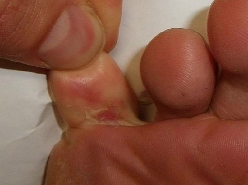 skin peeling between toes pictures 3