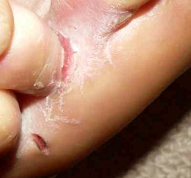 skin peeling between toes pictures