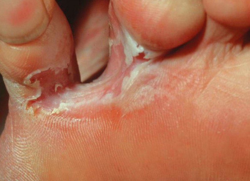 skin peeling between toes