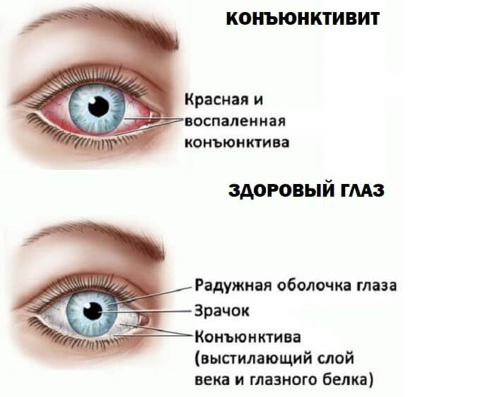 Воспаленная конъюнктива глазаВоспаленная конъюнктива глаза