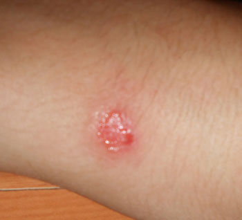 Причины появления болячки на коже
