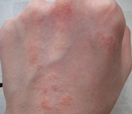 Сыпь на руках при дерматите