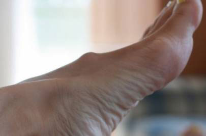 Уплотнение на ноге в виде шишки: причины, тревожные симптомы и особенности лечения