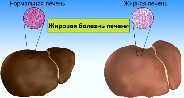 Диффузные изменения паренхимы поджелудочной железы