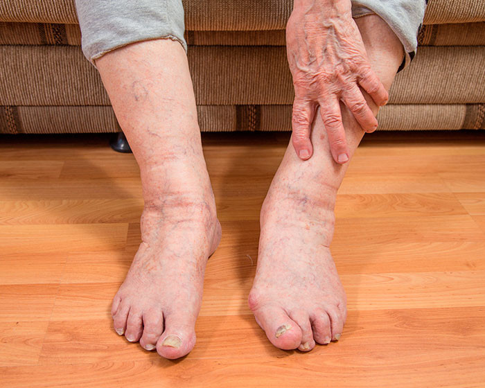 Причины отека ног у пожилых людей: как лечить