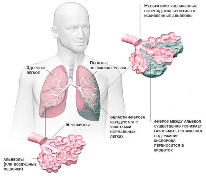 Развитие пневмосклероза легких