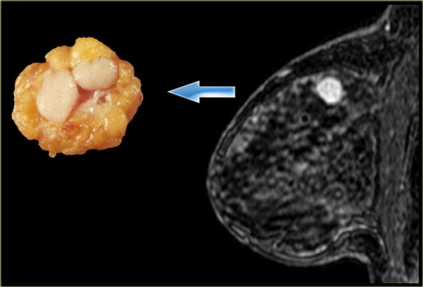Фиброаденома молочной железы