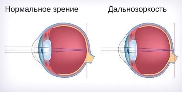 Фокусировка за сетчаткой глаза