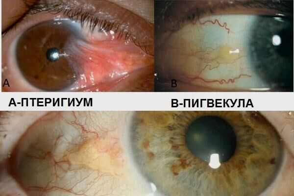 Симптоматика патологии перигиум