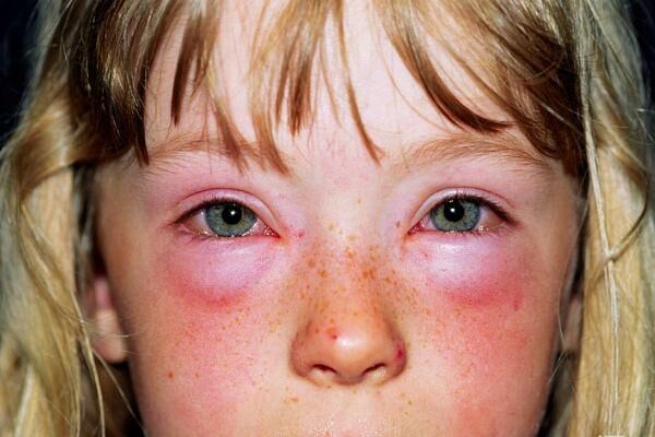 Слезотечение, покраснение, зуд глаз у детей при аллергии