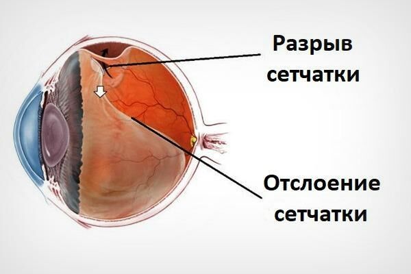 Разрыв сетчатки глаза