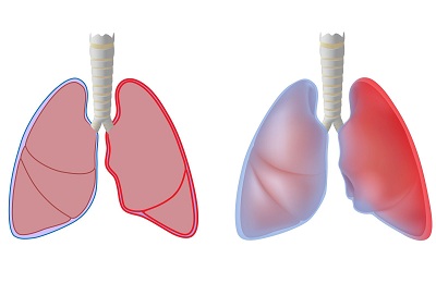 Больные легкие