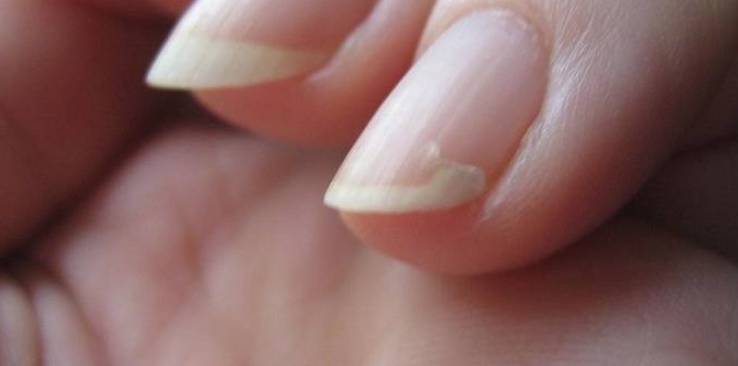 отнихолизис отслойка ногтя на руках