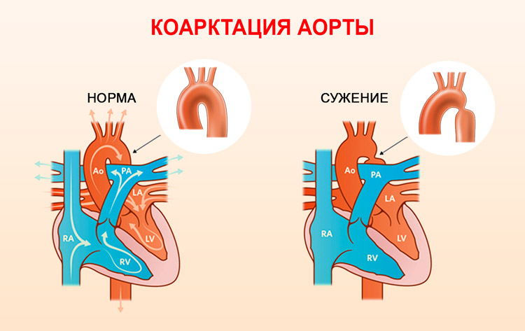 Коарктация аорты
