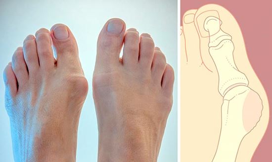 Шишки на ногах у большого пальца: причины и лечение