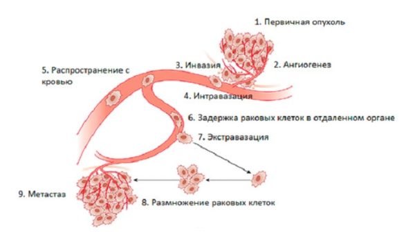 Метастазирование рака