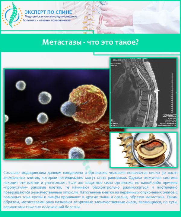 Метастазы - что это такое